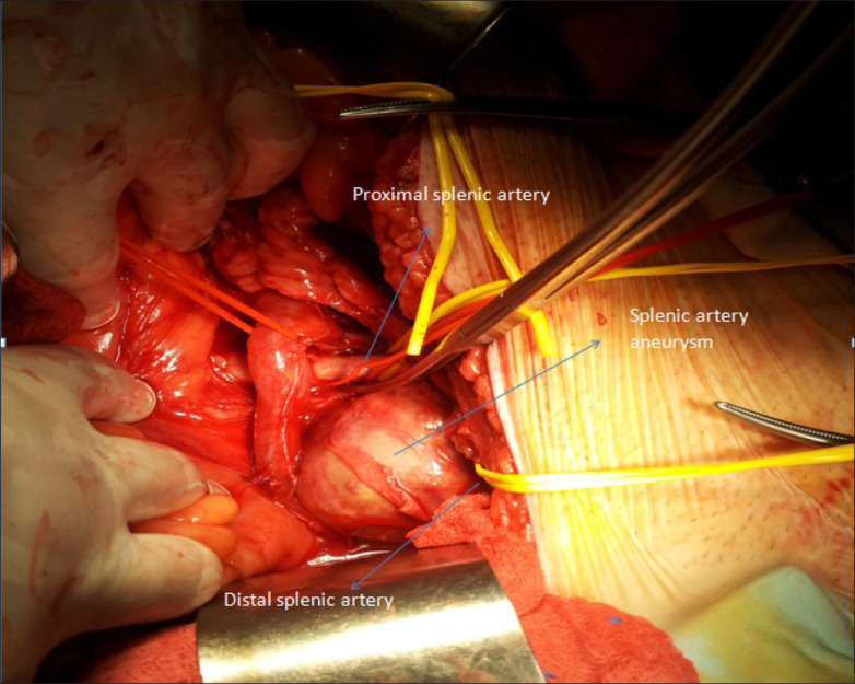 Giant splenic artery aneurysm treated surgically with spleen and pancreas preservation.