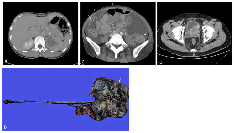 Paraneoplastic Leukemoid Reaction after Primary Tumor Resection in Patients with Urothelial Carcinoma: A Report of 2 Cases.