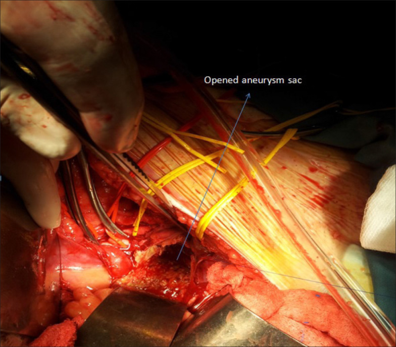 Giant splenic artery aneurysm treated surgically with spleen and pancreas preservation.