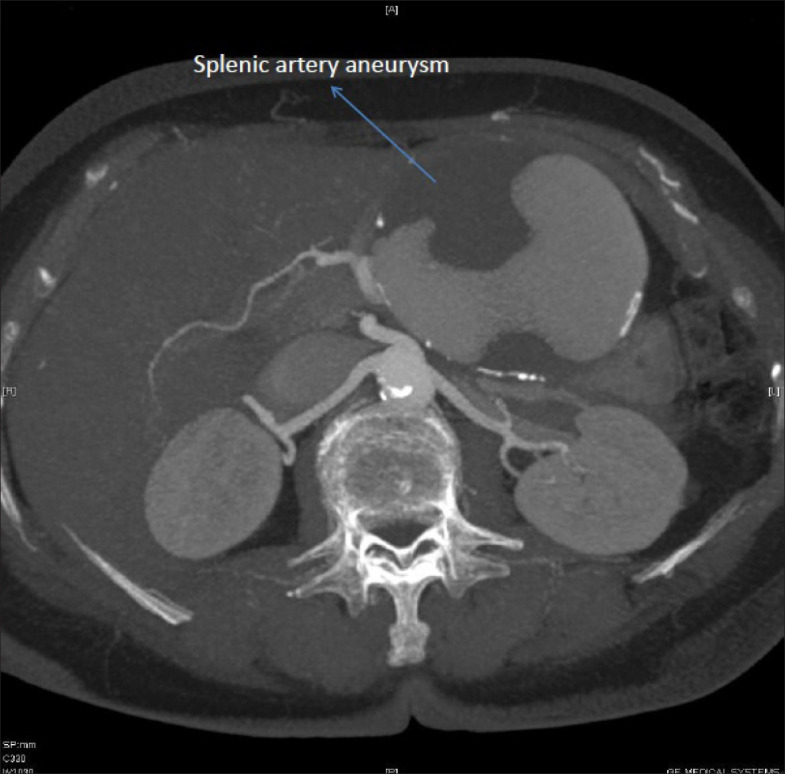 Giant splenic artery aneurysm treated surgically with spleen and pancreas preservation.