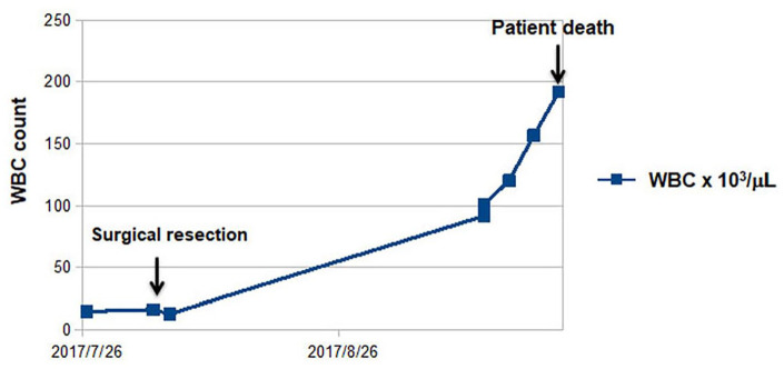 Paraneoplastic Leukemoid Reaction after Primary Tumor Resection in Patients with Urothelial Carcinoma: A Report of 2 Cases.