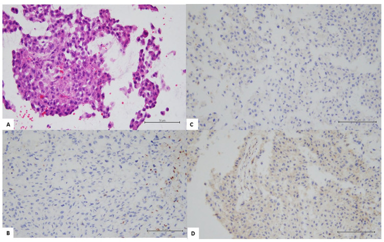 Paraneoplastic Leukemoid Reaction after Primary Tumor Resection in Patients with Urothelial Carcinoma: A Report of 2 Cases.