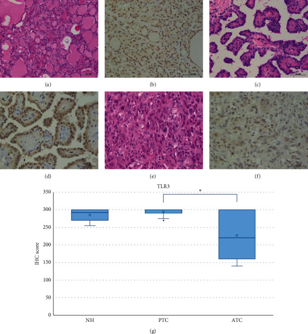 Immunohistochemical Analysis of Toll-Like Receptors, MyD88, and TRIF in Human Papillary Thyroid Carcinoma and Anaplastic Thyroid Carcinoma.