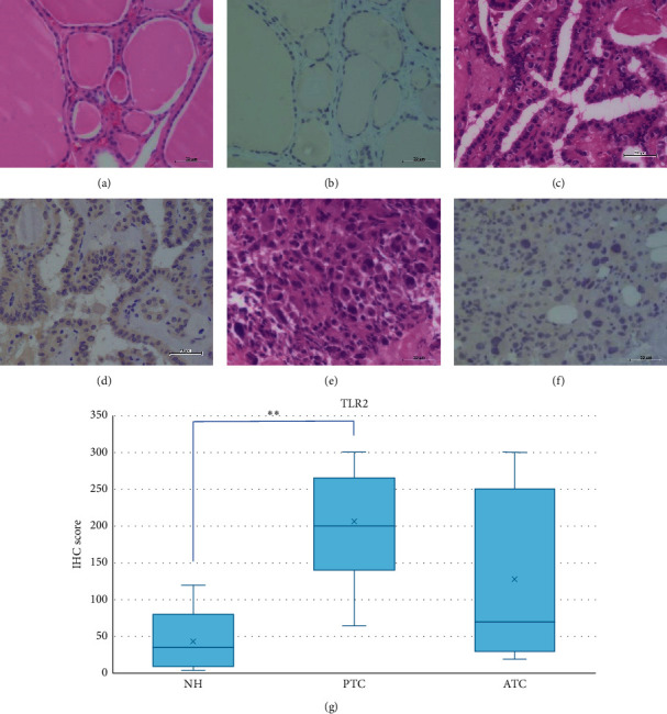 Immunohistochemical Analysis of Toll-Like Receptors, MyD88, and TRIF in Human Papillary Thyroid Carcinoma and Anaplastic Thyroid Carcinoma.