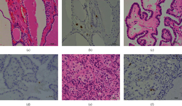 Immunohistochemical Analysis of Toll-Like Receptors, MyD88, and TRIF in Human Papillary Thyroid Carcinoma and Anaplastic Thyroid Carcinoma.