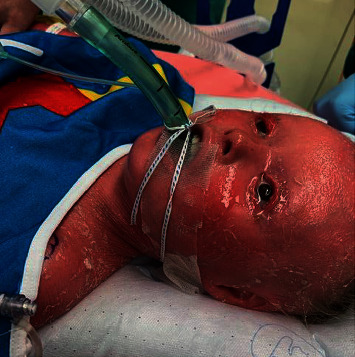 Anesthetic Management of a Patient with Harlequin Ichthyosis.