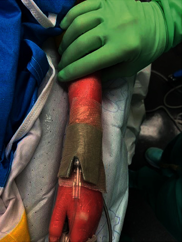 Anesthetic Management of a Patient with Harlequin Ichthyosis.