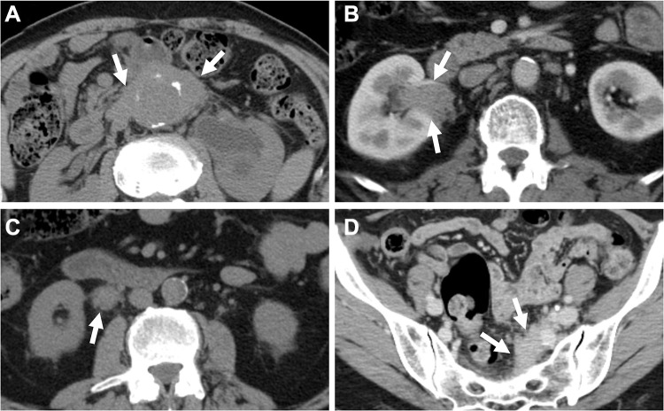 Renal Involvement in Retroperitoneal Fibrosis: Prevalence, Impact and Management Challenges.