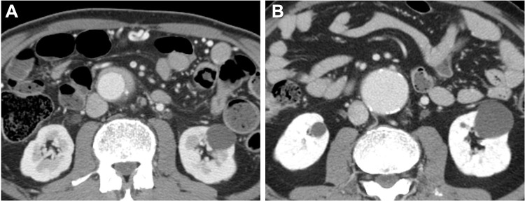 Renal Involvement in Retroperitoneal Fibrosis: Prevalence, Impact and Management Challenges.