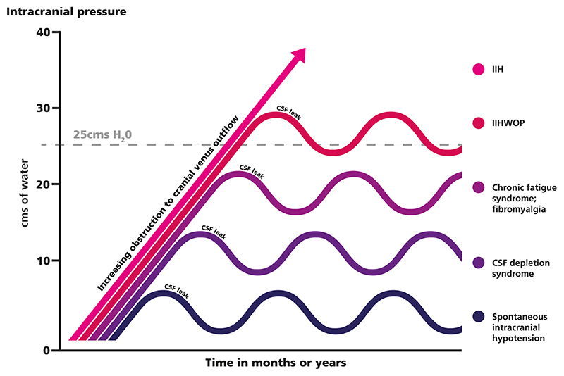 A paradigm for chronic fatigue syndrome: caught between idiopathic intracranial hypertension and spontaneous intracranial hypotension; caused by cranial venous outflow obstruction.