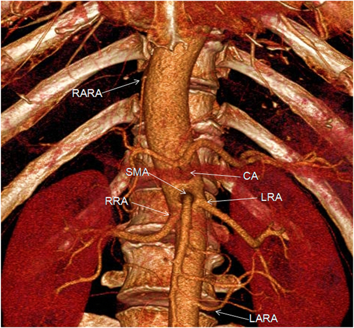 Common trunk of the right accessory renal artery and right inferior phrenic artery originating from the thoracic artery: An unreported variation