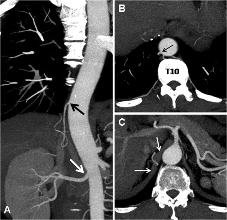 Common trunk of the right accessory renal artery and right inferior phrenic artery originating from the thoracic artery: An unreported variation