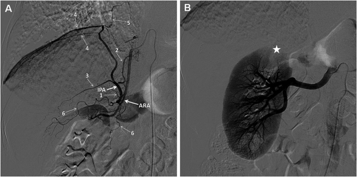 Common trunk of the right accessory renal artery and right inferior phrenic artery originating from the thoracic artery: An unreported variation