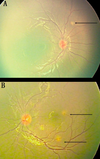 Miliary tuberculosis presenting as bilateral pseudo-retinoblastoma.