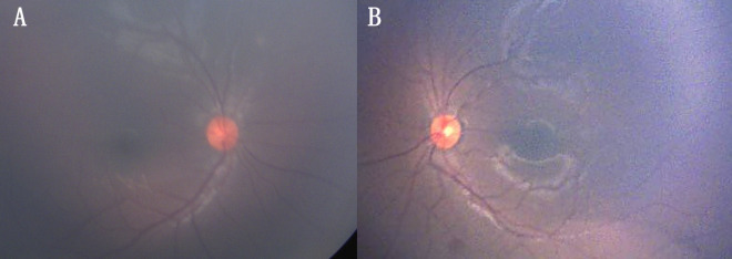 Miliary tuberculosis presenting as bilateral pseudo-retinoblastoma.