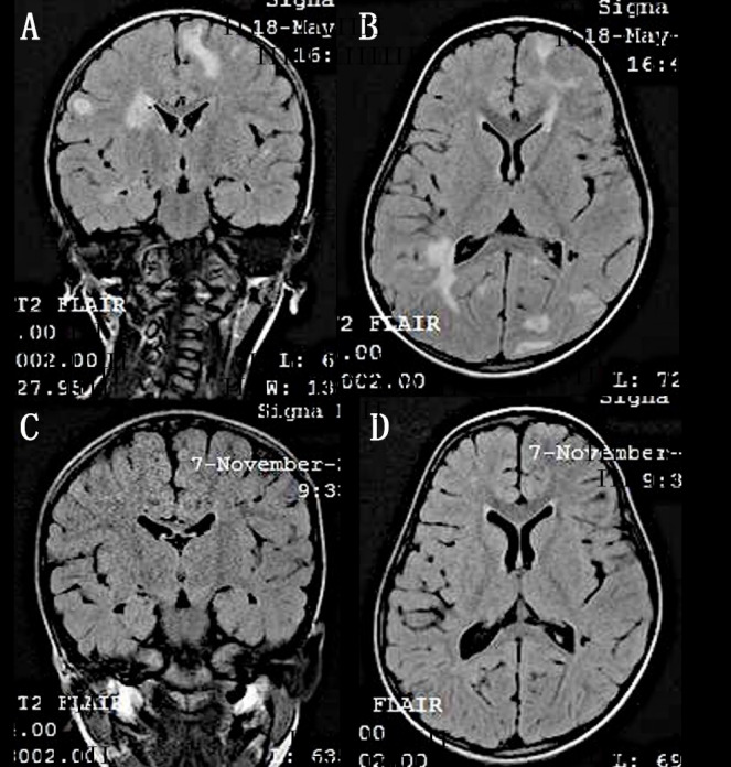 Miliary tuberculosis presenting as bilateral pseudo-retinoblastoma.