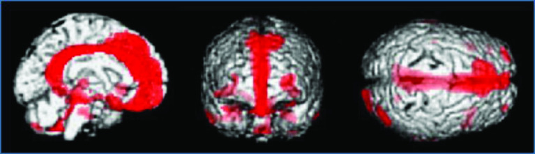 Altered biphasic serotonin discharge hypothesis in mild traumatic brain injury.