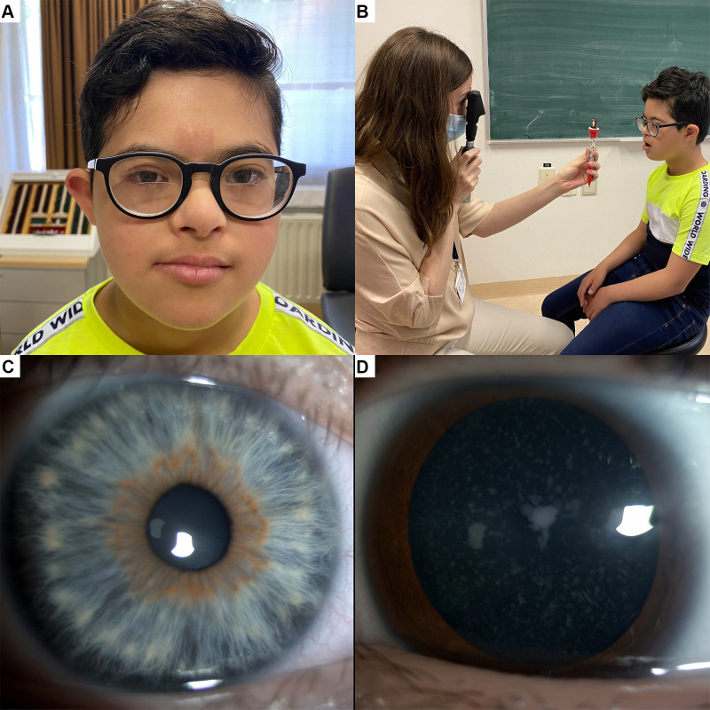 Neuro-Ophthalmological Manifestations in Children with Down Syndrome: Current Perspectives.