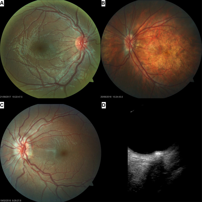 Neuro-Ophthalmological Manifestations in Children with Down Syndrome: Current Perspectives.