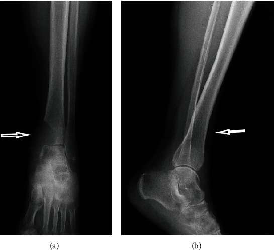 Metastatic Lesion of the Tibia from Renal Cell Carcinoma.