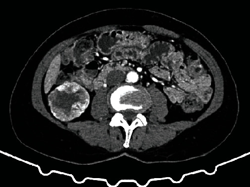 Metastatic Lesion of the Tibia from Renal Cell Carcinoma.