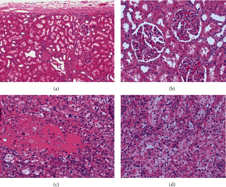 Metastatic Lesion of the Tibia from Renal Cell Carcinoma.