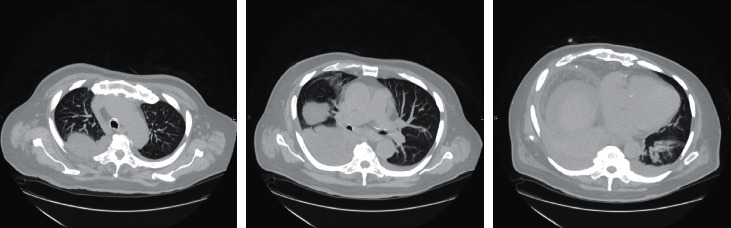 Refractory Spontaneous Bacterial Empyema in Cirrhotic Patient.