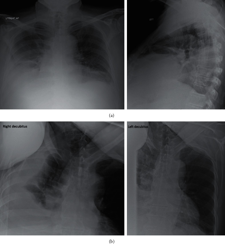 Refractory Spontaneous Bacterial Empyema in Cirrhotic Patient.