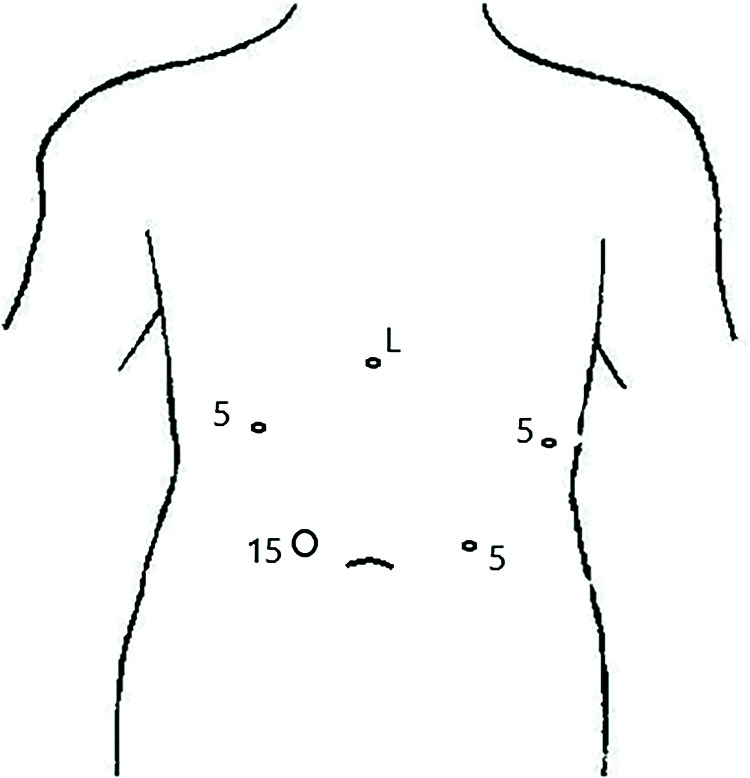 Proximal Gastrectomy Is a Viable Alternative to Total Gastrectomy in Early Stage Proximal Gastric Cancer.