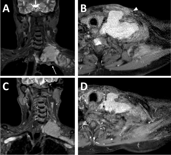 Fibromatoses of Head and Neck: Case Series and Literature Review.