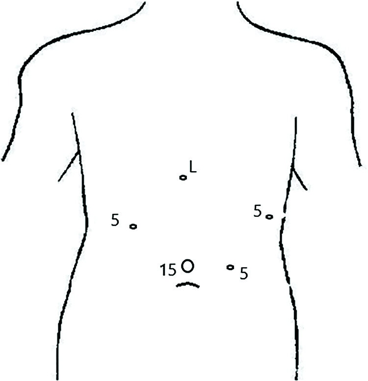 Proximal Gastrectomy Is a Viable Alternative to Total Gastrectomy in Early Stage Proximal Gastric Cancer.