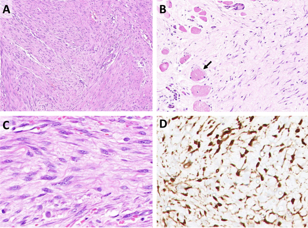 Fibromatoses of Head and Neck: Case Series and Literature Review.