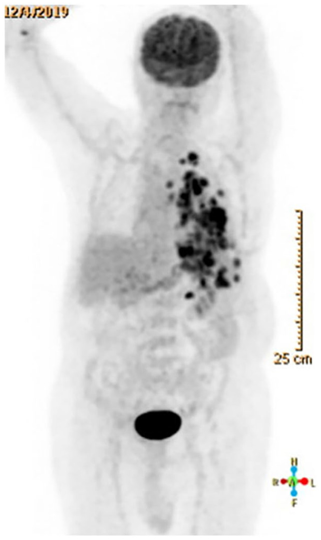 Lung Adenocarcinoma with Paraneoplastic Hyper-Eosinophilia Not Responding To Pembrolizumab.