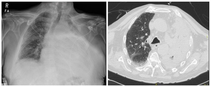 Lung Adenocarcinoma with Paraneoplastic Hyper-Eosinophilia Not Responding To Pembrolizumab.