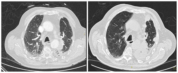 Lung Adenocarcinoma with Paraneoplastic Hyper-Eosinophilia Not Responding To Pembrolizumab.