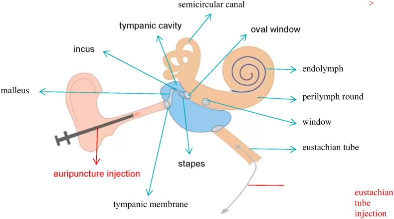 Intratympanic vs systemic use of steroids as first-line treatment for sudden hearing loss: A meta-analysis of randomized, controlled trials