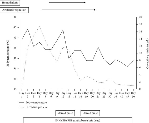 Effectiveness of Steroid Pulse Therapy for Systemic Side Effects after Bacillus Calmette-Guérin Intravesical Instillation Therapy: A Series of Five Cases.