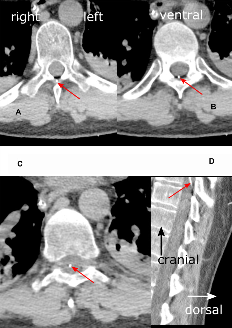 Serious Complications After Epidural Catheter Placement: Two Case Reports.