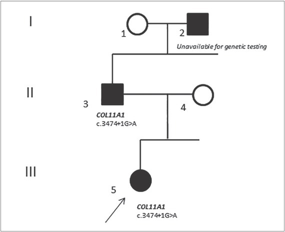 Novel Mutation in the <i>COL11A1</i> Gene Causing Marshall-Stickler Syndrome in Three Generations of a Bulgarian Family.