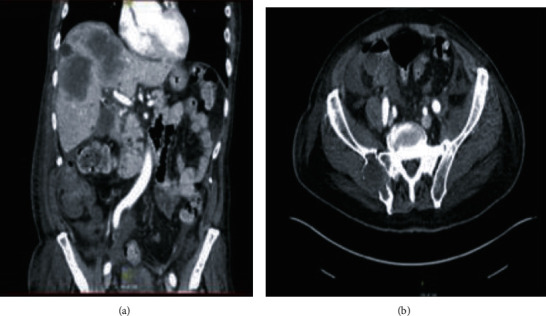 Malignant Priapism as a Result of Metastatic Thyroid Cancer: A Hard Reality.