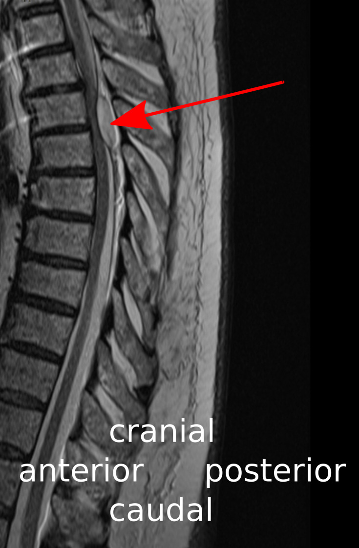 Serious Complications After Epidural Catheter Placement: Two Case Reports.