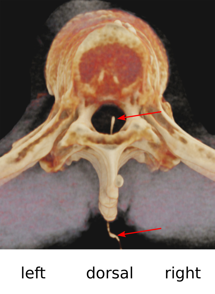 Serious Complications After Epidural Catheter Placement: Two Case Reports.