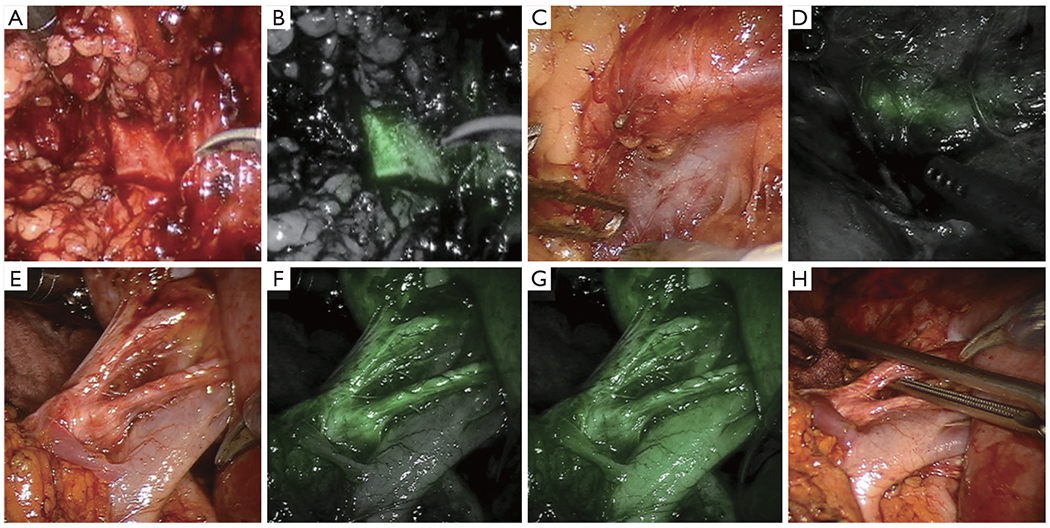 A narrative review of fluorescence imaging in robotic-assisted surgery.