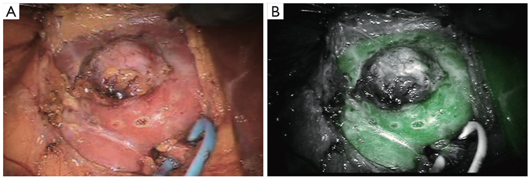 A narrative review of fluorescence imaging in robotic-assisted surgery.