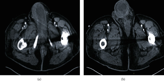 Malignant Priapism as a Result of Metastatic Thyroid Cancer: A Hard Reality.