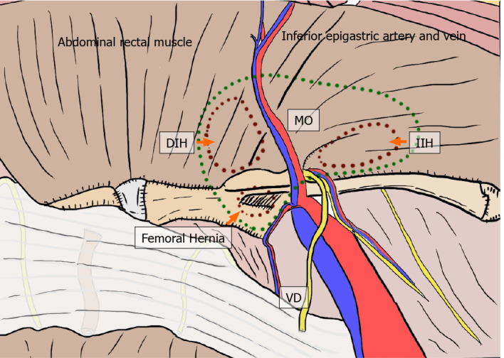 Fascinating history of groin hernias: Comprehensive recognition of anatomy, classic considerations for herniorrhaphy, and current controversies in hernioplasty.