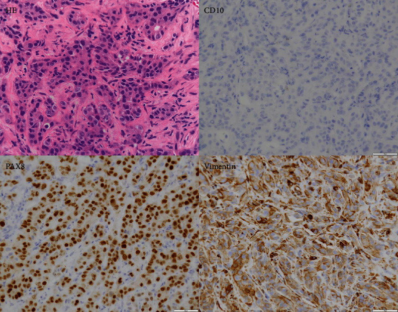 Nivolumab and Ipilimumab Combination Immunotherapy for Patients with Metastatic Collecting Duct Carcinoma.