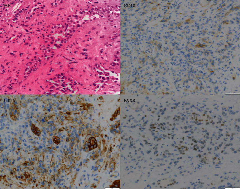 Nivolumab and Ipilimumab Combination Immunotherapy for Patients with Metastatic Collecting Duct Carcinoma.