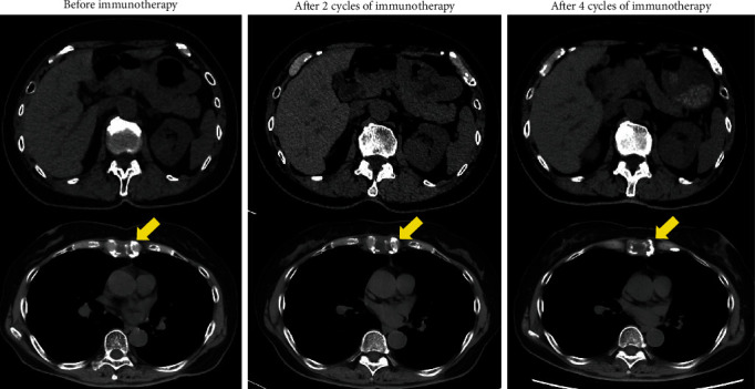 Nivolumab and Ipilimumab Combination Immunotherapy for Patients with Metastatic Collecting Duct Carcinoma.