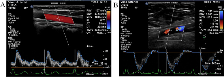 Ultrasonography to detect cardiovascular damage in children with essential hypertension.